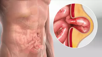 Ai o umflătură în zona buricului? Semnul care poate indica o hernie ombilicală
