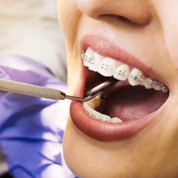 (P) Lucruri de știut dacă vrei să îți pui aparat dentar: preț și beneficii
