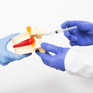 Hernia de disc: o provocare dureroasă a sistemului musculo-scheletic
