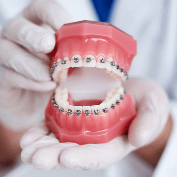 Aparat dentar fix sau mobil: Care este mai potrivit pentru corectarea dinților?