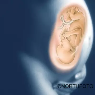 Întreruperea de sarcină şi dreptul la viaţă