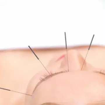 Zhendao, acupunctură cu un singur ac 