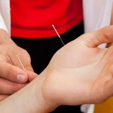 Cum vindecă acupunctura