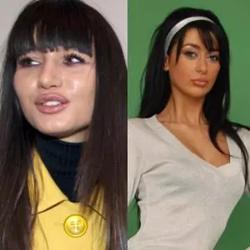 5 vedete urâţite de operaţiile estetice