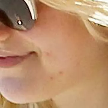 Plină de coşuri! Vezi ce actriţă are probleme grave cu tenul