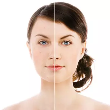 Acnee: Cum să previi apariţia coşurilor