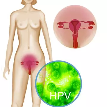 HPV - virusul care te poate ucide