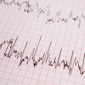 Ce este aritmia cardiacă
