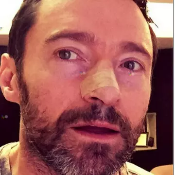 Hugh Jackman are carcinom bazocelular. Află totul despre acest cancer de piele!