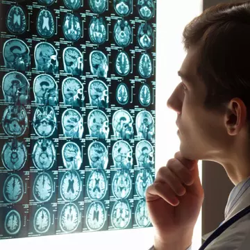 Cancerul cerebral: Care sunt simptomele unei tumori pe creier