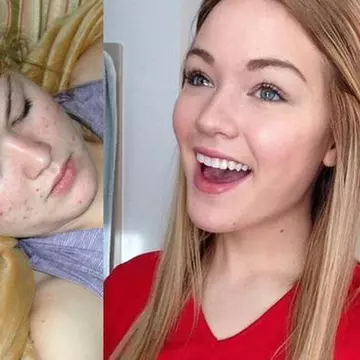 Transformarea uluitoare a fetei pline de coşuri. Cum să scapi de acnee