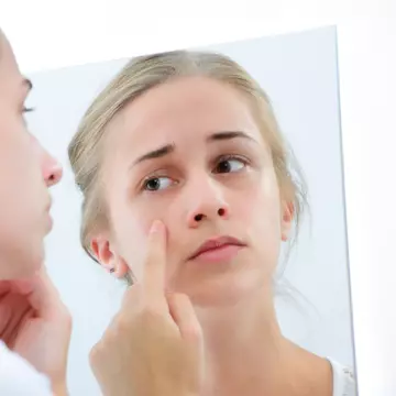 Cum îţi dai seama că ai acnee hormonală