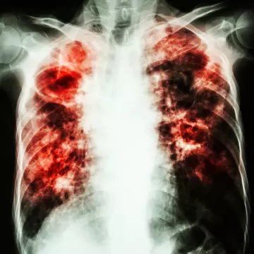 Cum știi că ai tuberculoză 