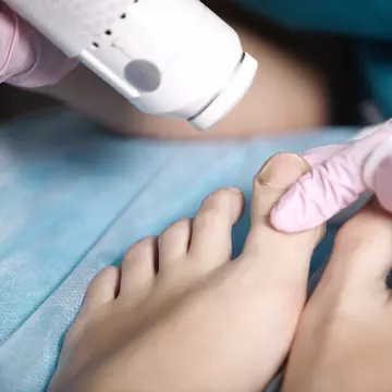 Cum tratezi corect o unghie infectată