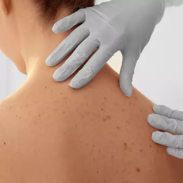 Cum recunoști cele mai comune tipuri de cancer de piele