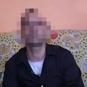 Povestea românului care a trăit cu o jumătate de craniu