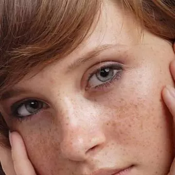 10 remedii naturale contra pistruilor