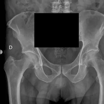 Un bătrânel de 94 de ani s-a dus la spital cu dureri crunte de burtă. Medicii, uimiţi de ce avea în abdomen. Era acolo de 70 de ani