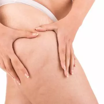 Cum scapi într-o lună de celulită, cu 3 ingrediente pe care le ai în casă
