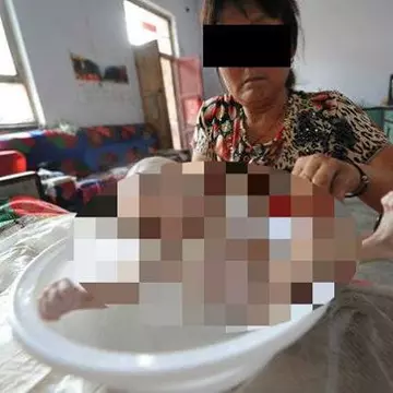 De necrezut! El este copilul născut fără anus