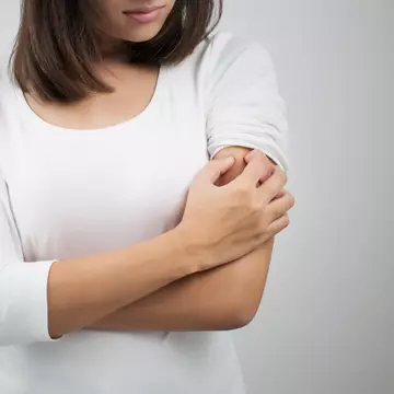 Cum tratezi mușcăturile de țânțari în mod natural