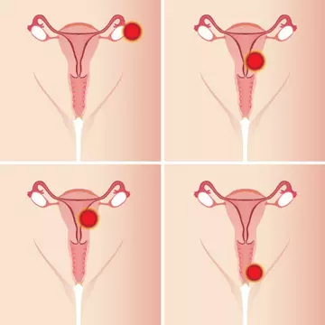 Remedii naturale împotriva durerilor menstruale