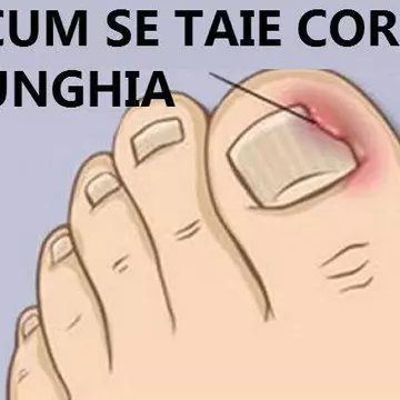 Cum tratezi unghiile încarnate