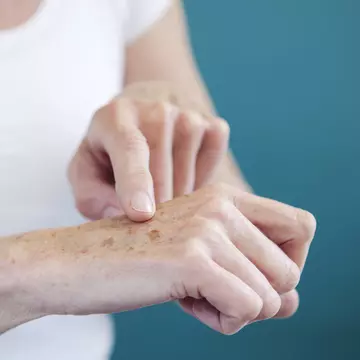 Cum să scapi de petele pigmentare de pe mâini, folosind un remediu natural