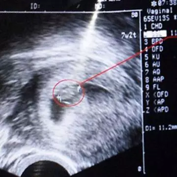 Cumplit! O tânără de 23 de ani, nevoită să avorteze pentru că pruncul său devenea ”sirenă”