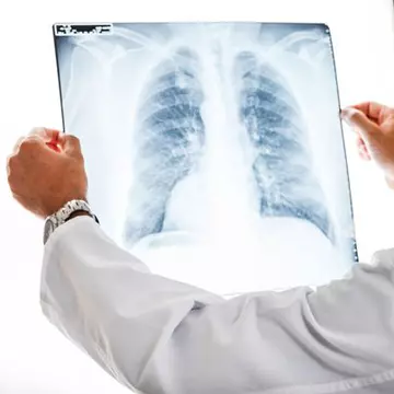 De câte tipuri este pneumonia și ce simptome ar trebui să îți dea de bănuit