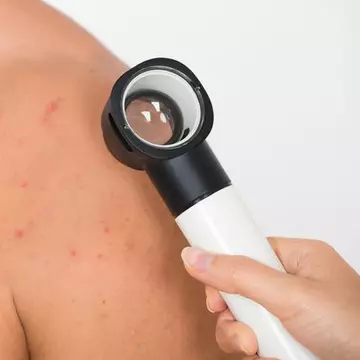 Foliculita