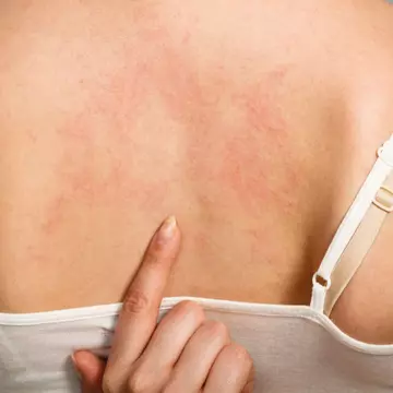 A doua zi după moartea subită a tatălui, adolescenta s-a trezit cu pete roșii pe tot corpul