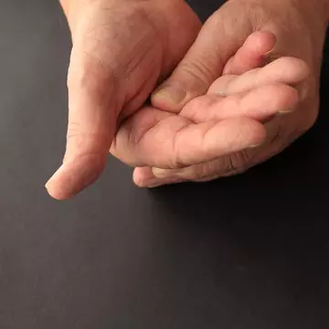 Sindromul de canal carpian te poate trezi noaptea