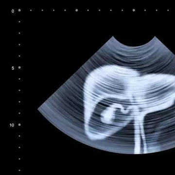 Simptomele hepatitei A. Cum le recunosti