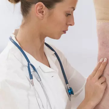Scleroterapia. Cum să scapi de varice și de venele pânză de păianjen