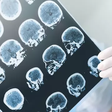 Și-a mușcat limba în somn, iar în următoarea noapte a murit subit. Ce boală avea tânărul de 26 de ani