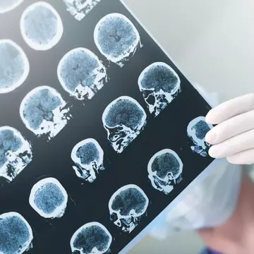 Accident vascular cerebral (AVC)
