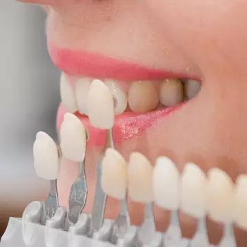 (P) Obtine un zambet unic cu fatete dentare personalizate 100%