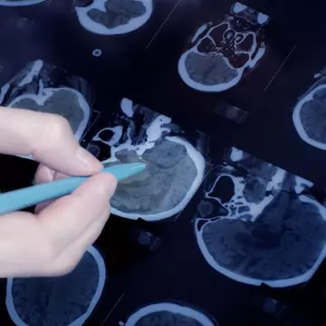 Studiu: O singură lovitură la cap crește riscul de apariție a bolii Parkinson