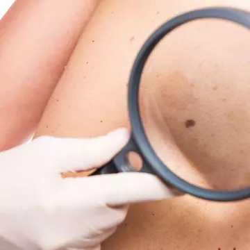 Care sunt simptomele cancerului de piele