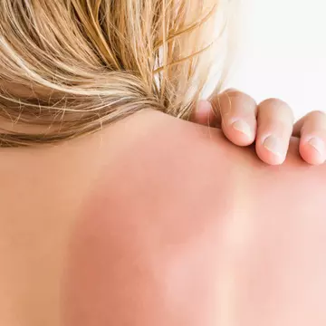 Remedii pentru arsuri solare