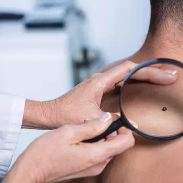 Decesele cauzate de cancerul de piele au crescut semnificativ în rândul bărbaților în ultimii 30 de ani