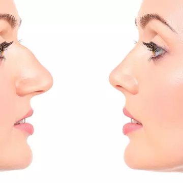 (P) Top 3 situații când este recomandat să apelezi la o intervenție de rinoplastie