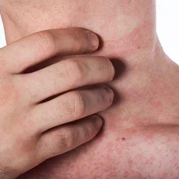 Atenție la iritațiile apărute pe piele! Pot fi un simptom al infecției cu coronavirus