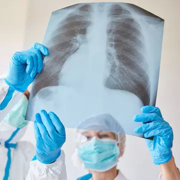 O femeie de 39 de ani, fără alte boli, a murit de COVID-19. Medic: "Nu mai avea suprafață pulmonară pentru a respira"