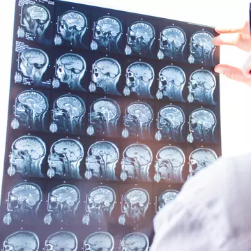 Ce poți face pentru a preveni atacul cerebral