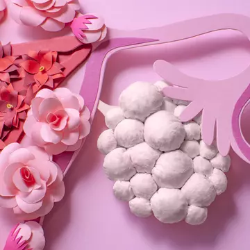 Suferi de ovare micropolichistice? Iată tot ce trebuie să știi