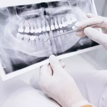 Doza de istorie - Cum au apărut implanturile dentare