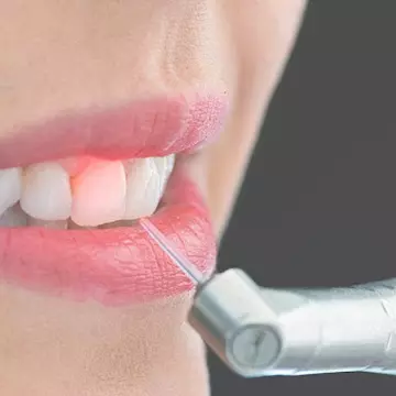 15 motive pentru a trata parodontoza cu laser