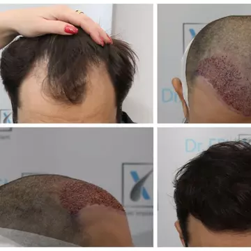 Dacă implantul de păr este soluția, nu amânați intervenția la Dr. Felix Hair Implant